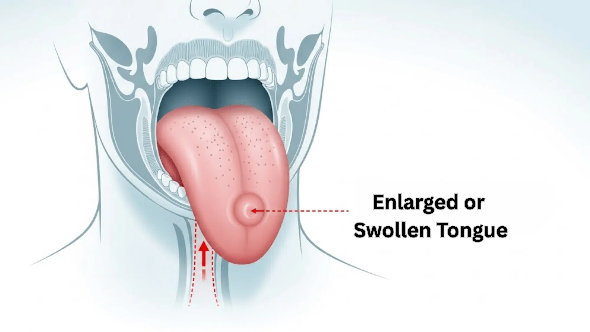 Enlarged-or-Swollen-Tongue