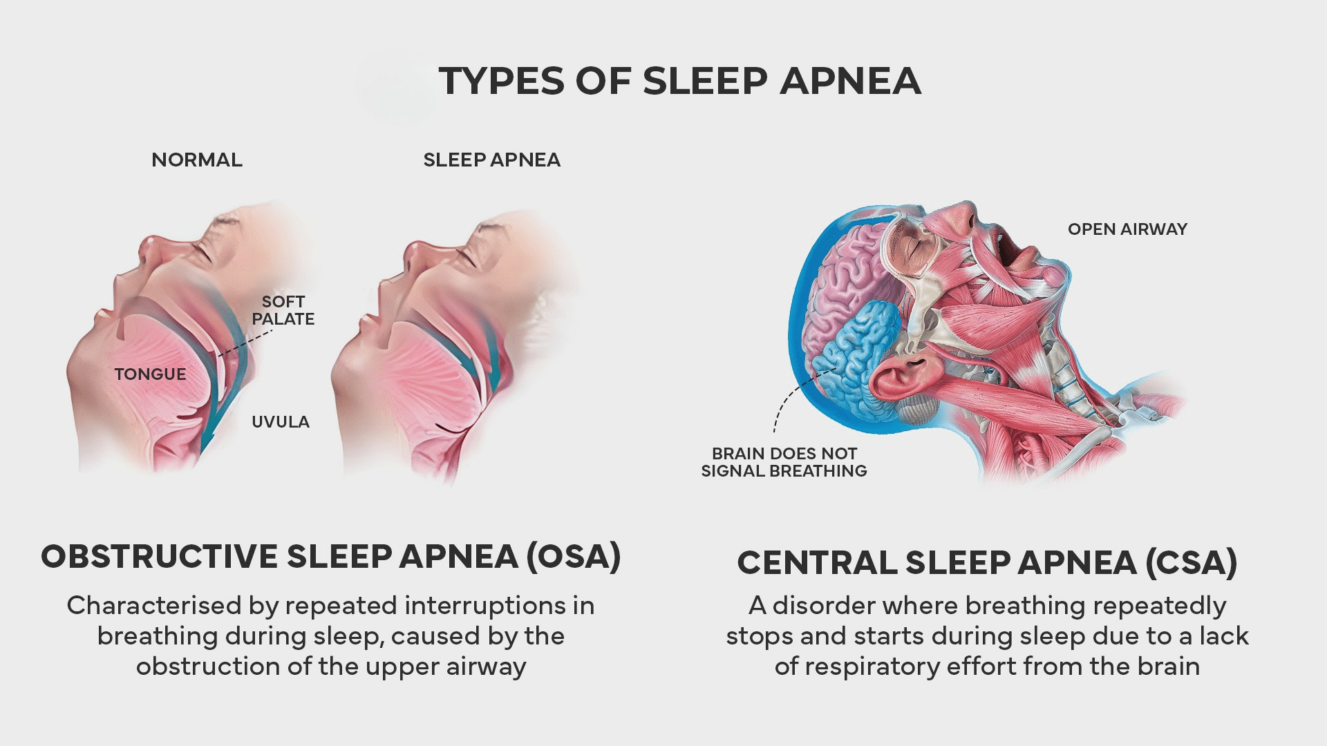 Types of Sleep Apnea