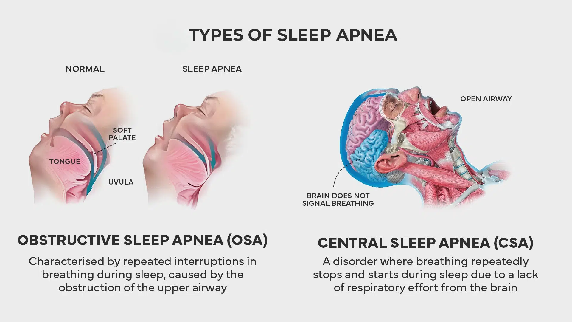 Types of Sleep Apnea
