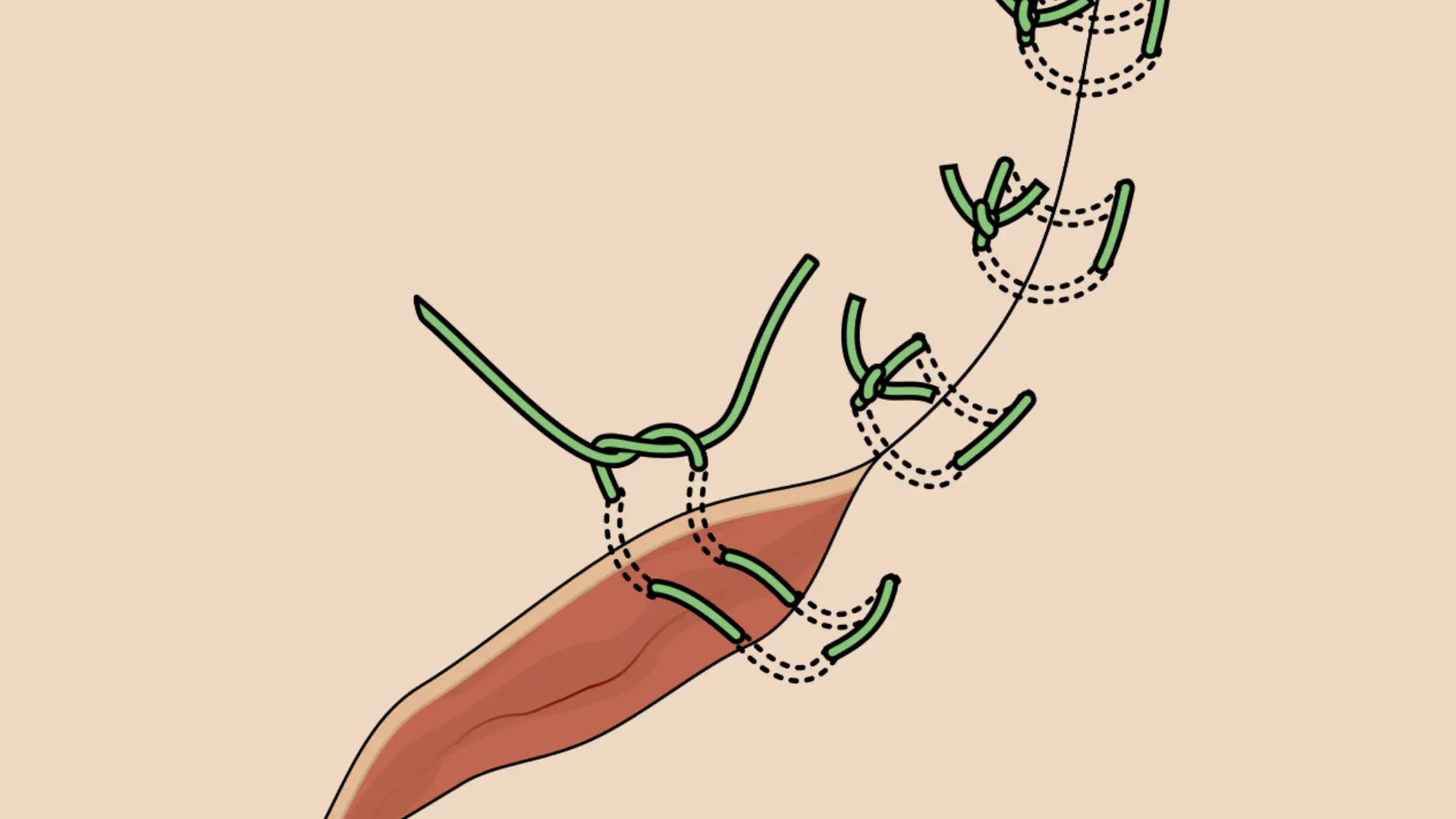 Why-Horizontal-Mattress-Sutures