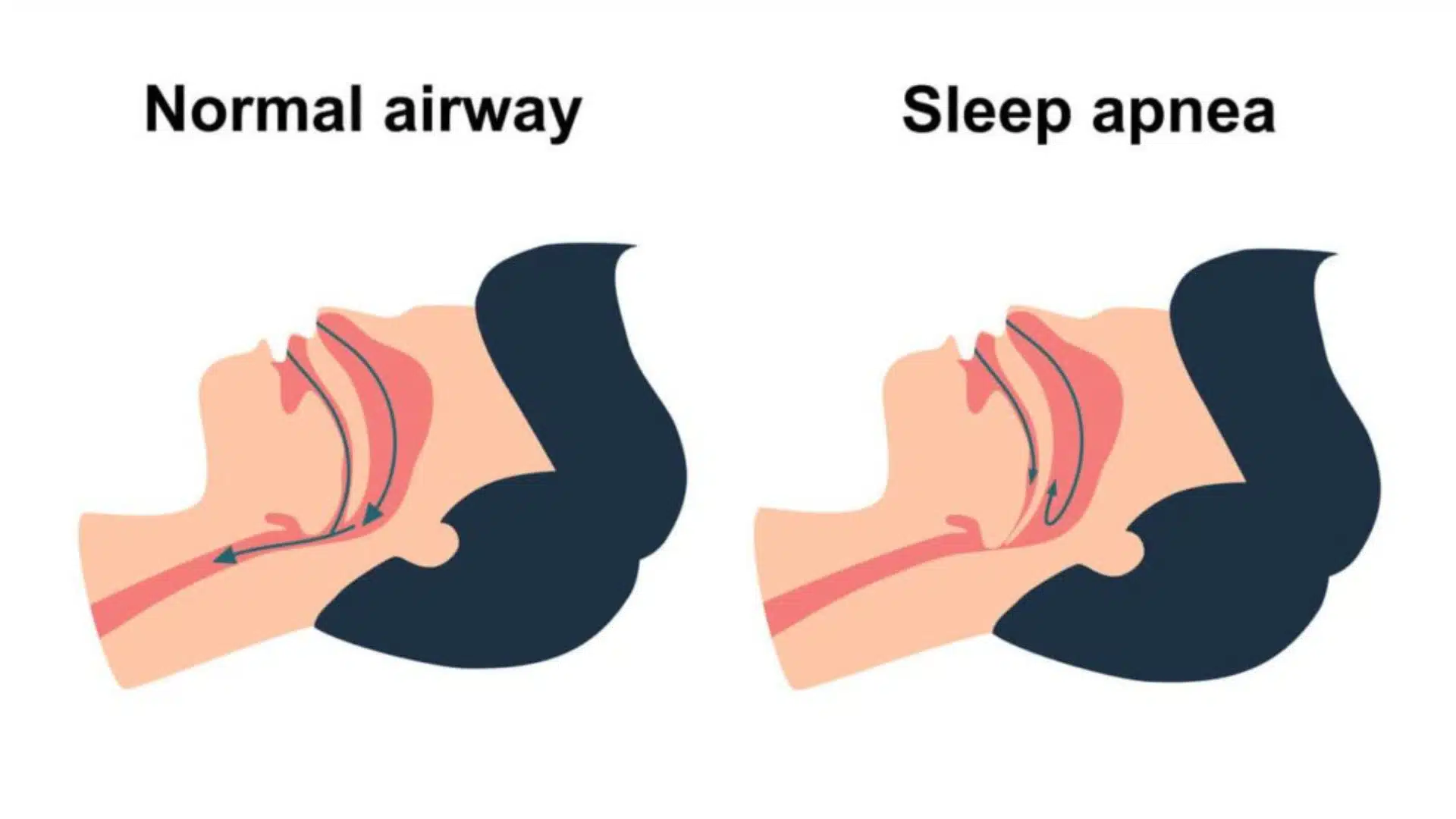 Diagram comparing normal airway breathing and sleep apnea, showing blocked airflow caused by airway collapse during sleep.