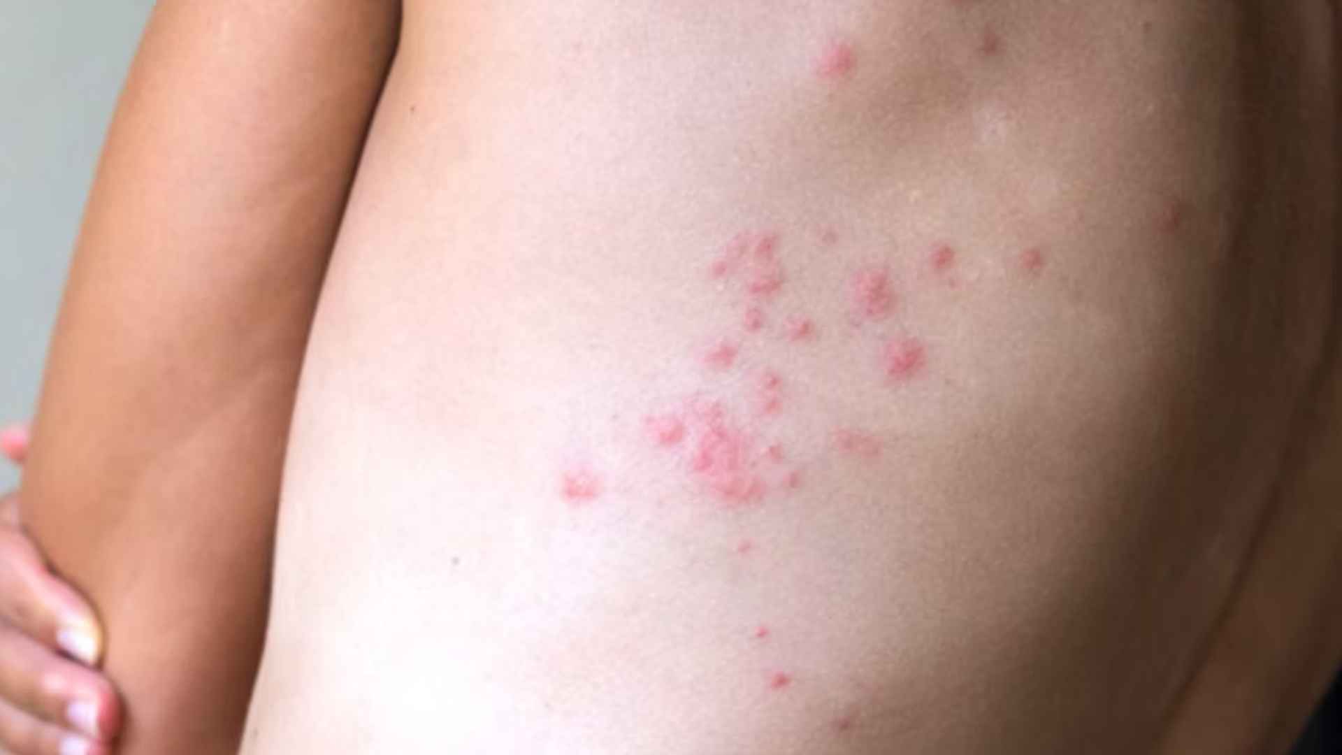 Clustered red bed bug bites on human back skin