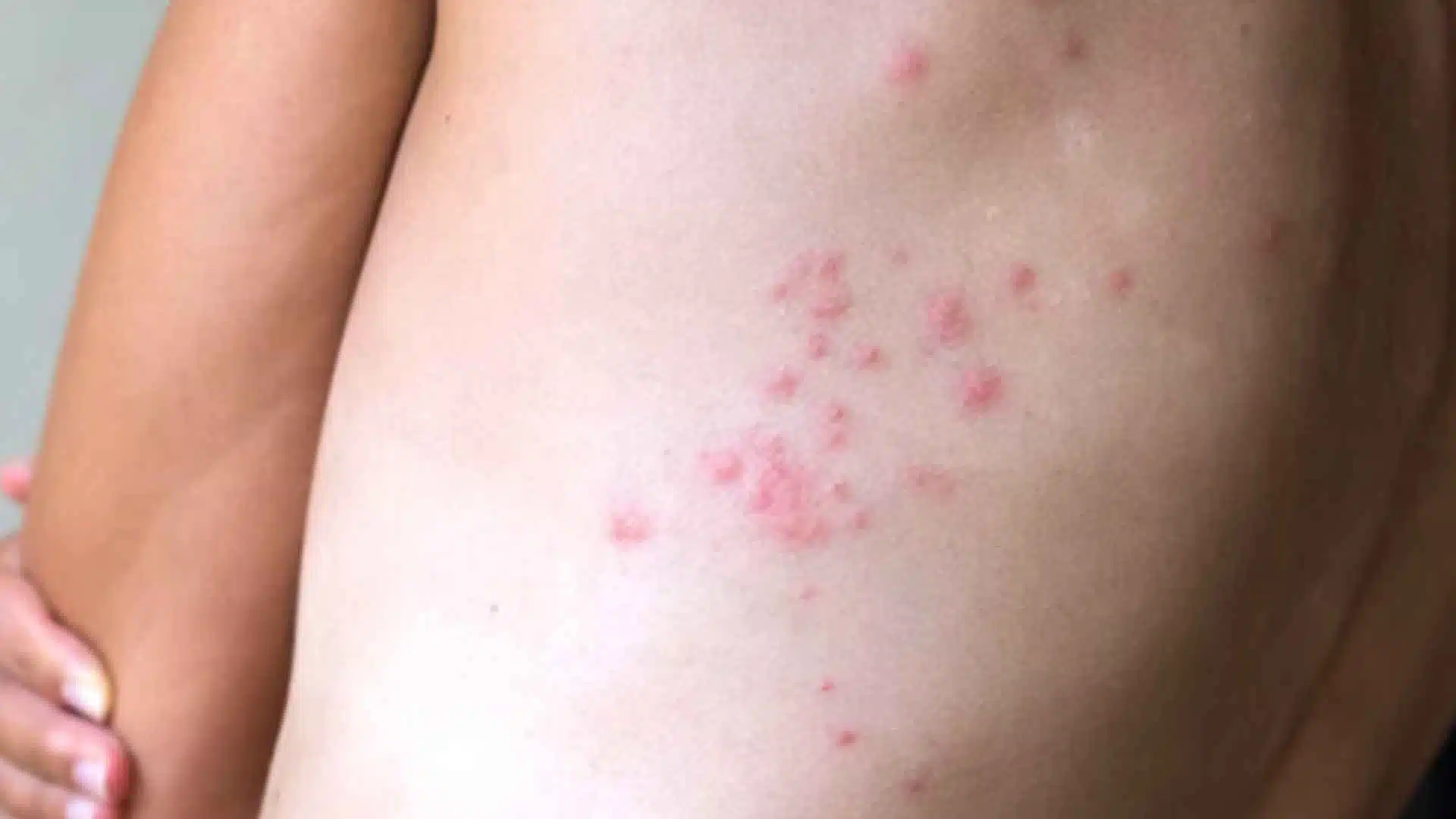 Clustered red bed bug bites on human back skin