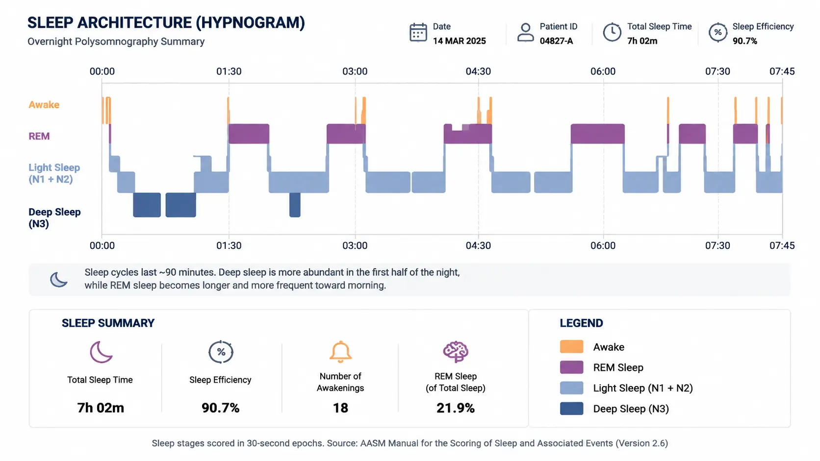 Polysomnography hypnogram showing REM, light, and deep sleep stages across night with summary sleep metrics