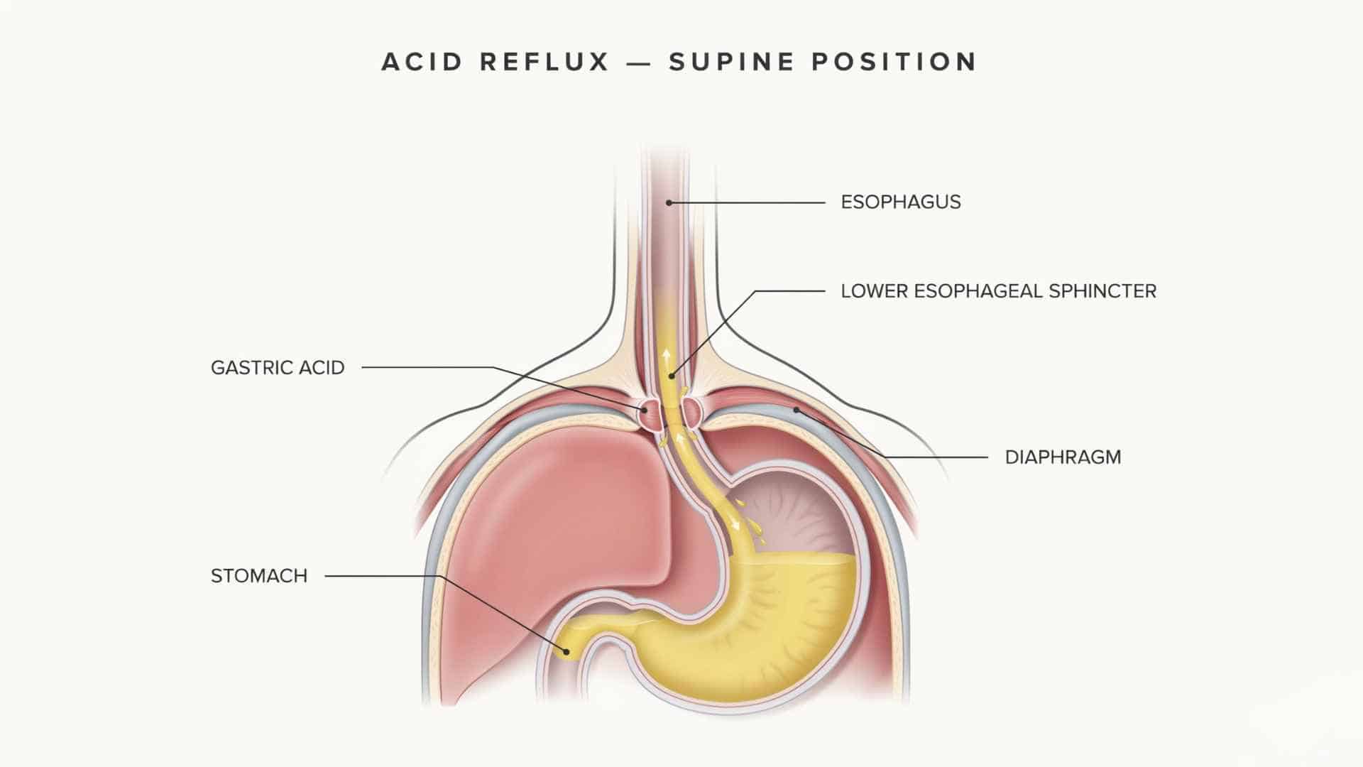 Medical diagram showing stomach acid flowing backward into the esophagus when a person lies flat in bed