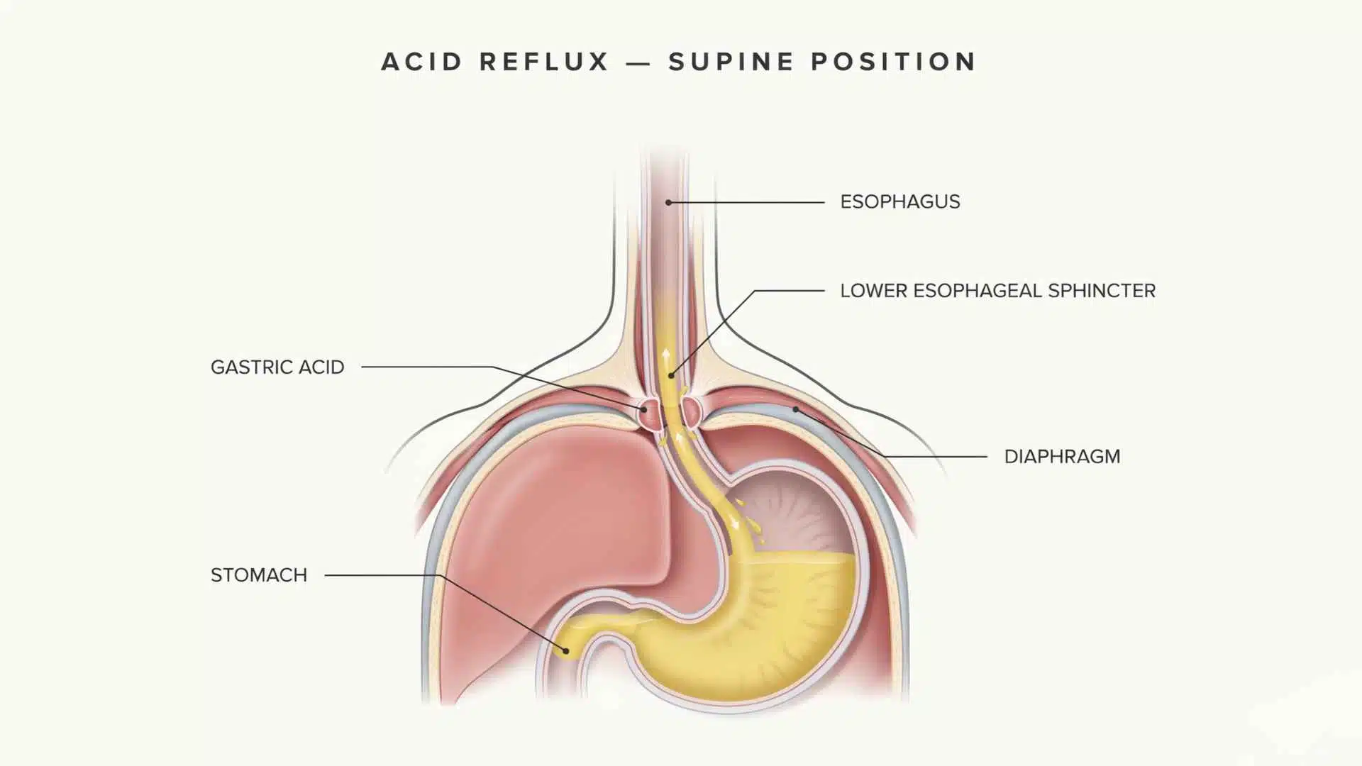 Medical diagram showing stomach acid flowing backward into the esophagus when a person lies flat in bed